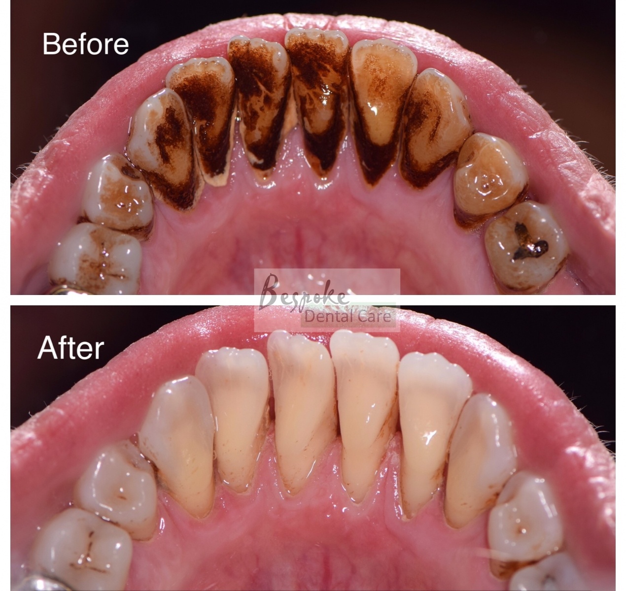 Before and After Smiles Gallery Bespoke Dental Care Gravesend